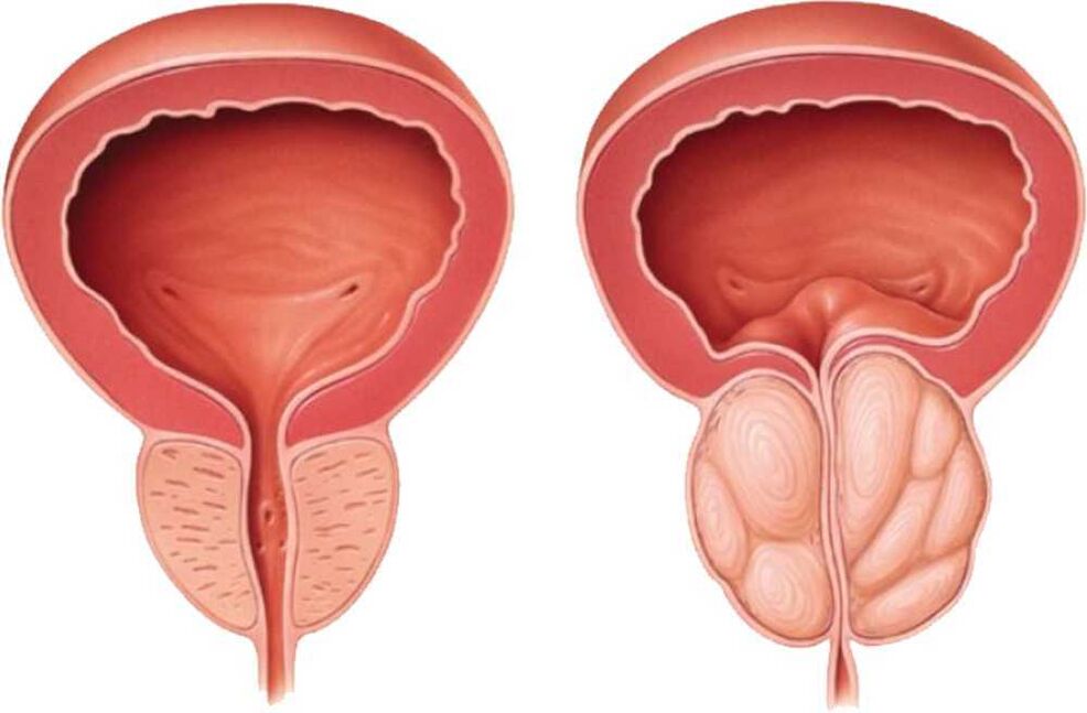 Prostate pain