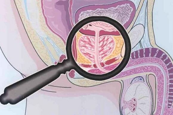 Prostate disease