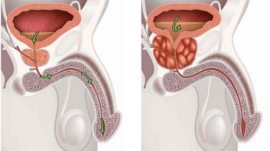 Prostatitis in men